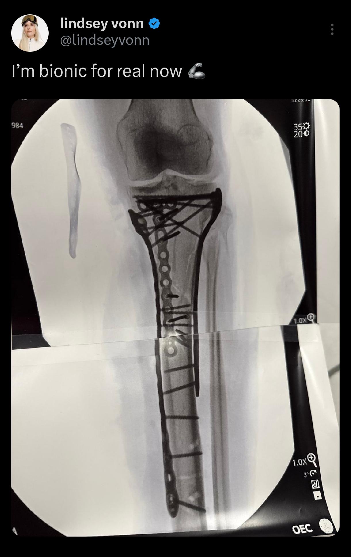 X-ray picture. Bone, several metal plates and a lot of screws.